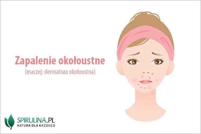 Jak radzić sobie z zapaleniem okoloustnym – objawy i skuteczne metody leczenia