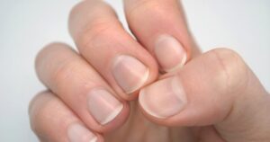 Jak skutecznie zapobiegać rozdwajaniu paznokci i dbać o ich zdrowie?