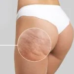 Skuteczne metody walki z cellulitem na nogach