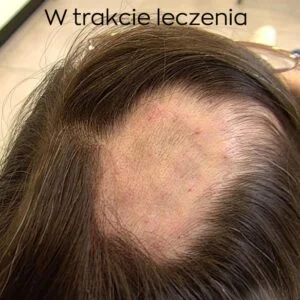 Skuteczne metody walki z lysieniem: Odkryj, jak przywrócić gęstość włosów